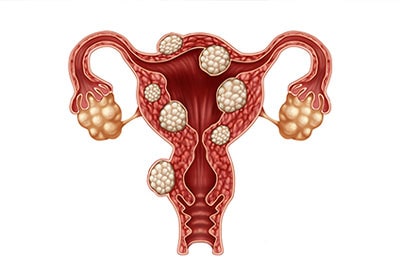 کیست و فیبروم